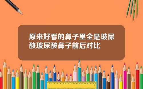 原来好看的鼻子里全是玻尿酸玻尿酸鼻子前后对比