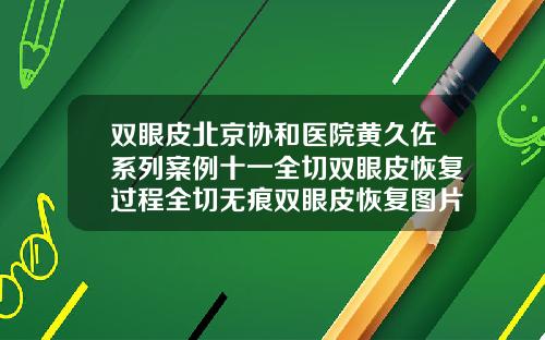 双眼皮北京协和医院黄久佐系列案例十一全切双眼皮恢复过程全切无痕双眼皮恢复图片