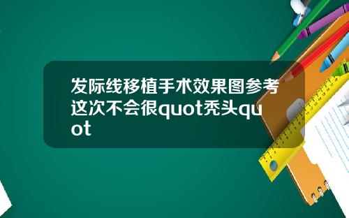 发际线移植手术效果图参考这次不会很quot秃头quot