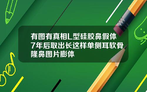 有图有真相L型硅胶鼻假体7年后取出长这样单侧耳软骨隆鼻图片膨体
