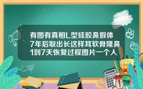 有图有真相L型硅胶鼻假体7年后取出长这样耳软骨隆鼻1到7天恢复过程图片一个人