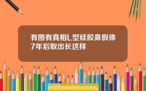 有图有真相L型硅胶鼻假体7年后取出长这样