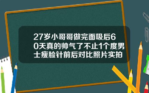 27岁小哥哥做完面吸后60天真的帅气了不止1个度男士瘦脸针前后对比照片实拍
