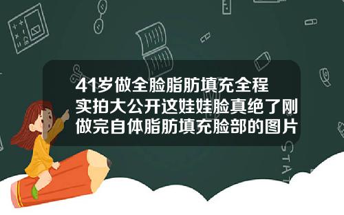 41岁做全脸脂肪填充全程实拍大公开这娃娃脸真绝了刚做完自体脂肪填充脸部的图片