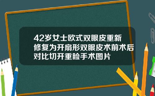 42岁女士欧式双眼皮重新修复为开扇形双眼皮术前术后对比切开重睑手术图片