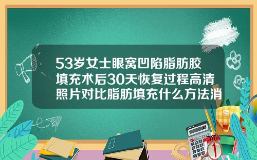 53岁女士眼窝凹陷脂肪胶填充术后30天恢复过程高清照片对比脂肪填充什么方法消肿快