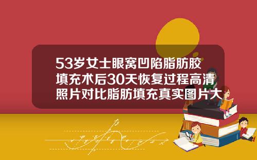 53岁女士眼窝凹陷脂肪胶填充术后30天恢复过程高清照片对比脂肪填充真实图片大全