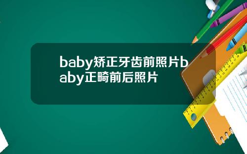 baby矫正牙齿前照片baby正畸前后照片